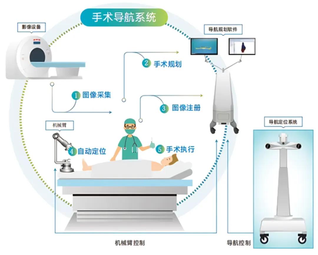 国产骨科手术机器人“锟铻”在巴西完成首例商业临床手术(图1)