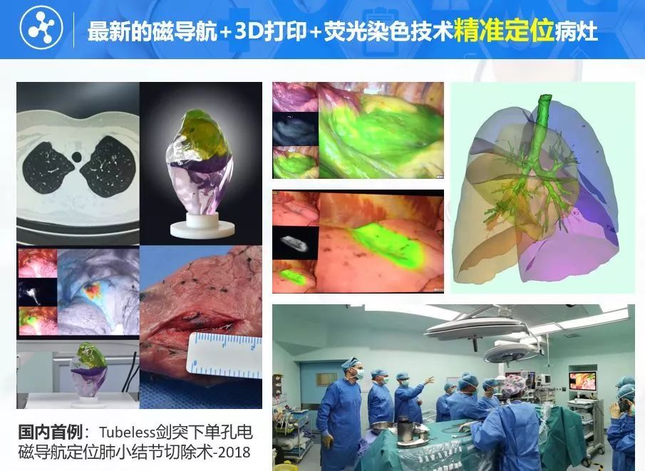 磁导航肺结节无痛定位+单孔微创一站式切除避免定位针并发症(图1)